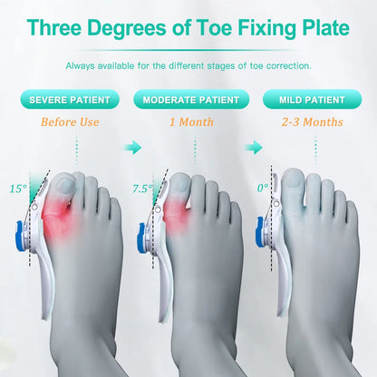 Orthopedic Bunion & Toe Corrector Success